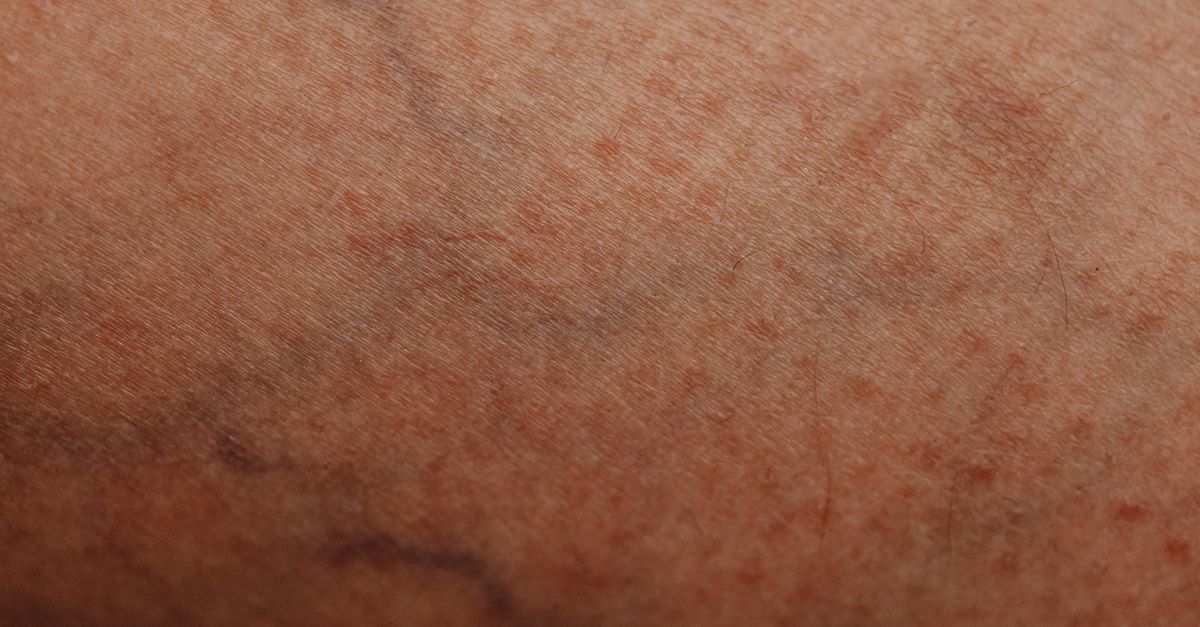 Is Dry Skin Normal in PCOS?