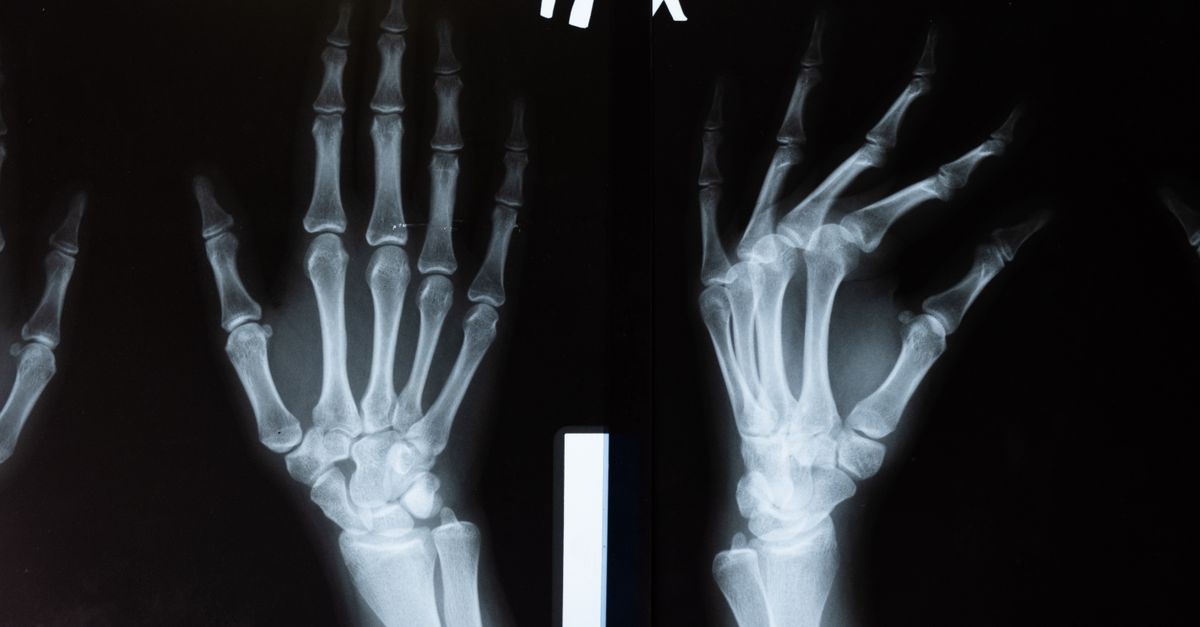 Should Women Get Calcium Tested?