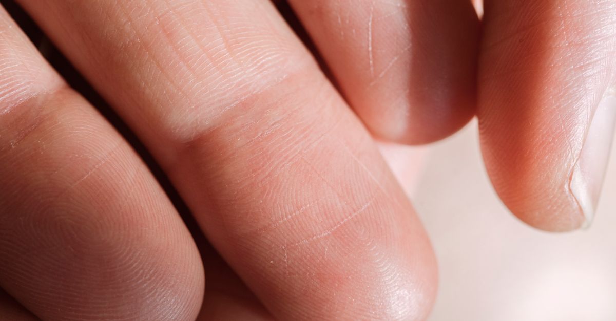 What Causes Dry Skin in PCOS?