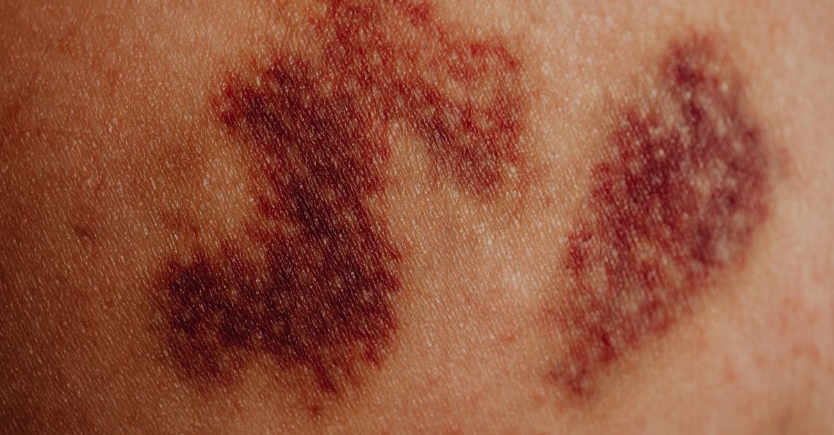 What Causes Itchy Skin with Fibroids?