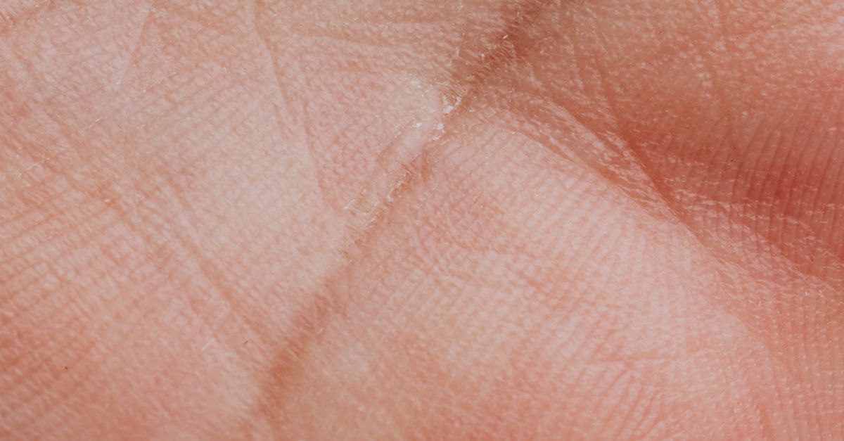 What Causes Thinning Skin with Fibroids?