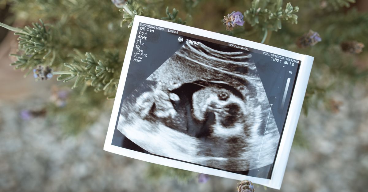 What Happens to Anti-Müllerian Hormone with PCOS?