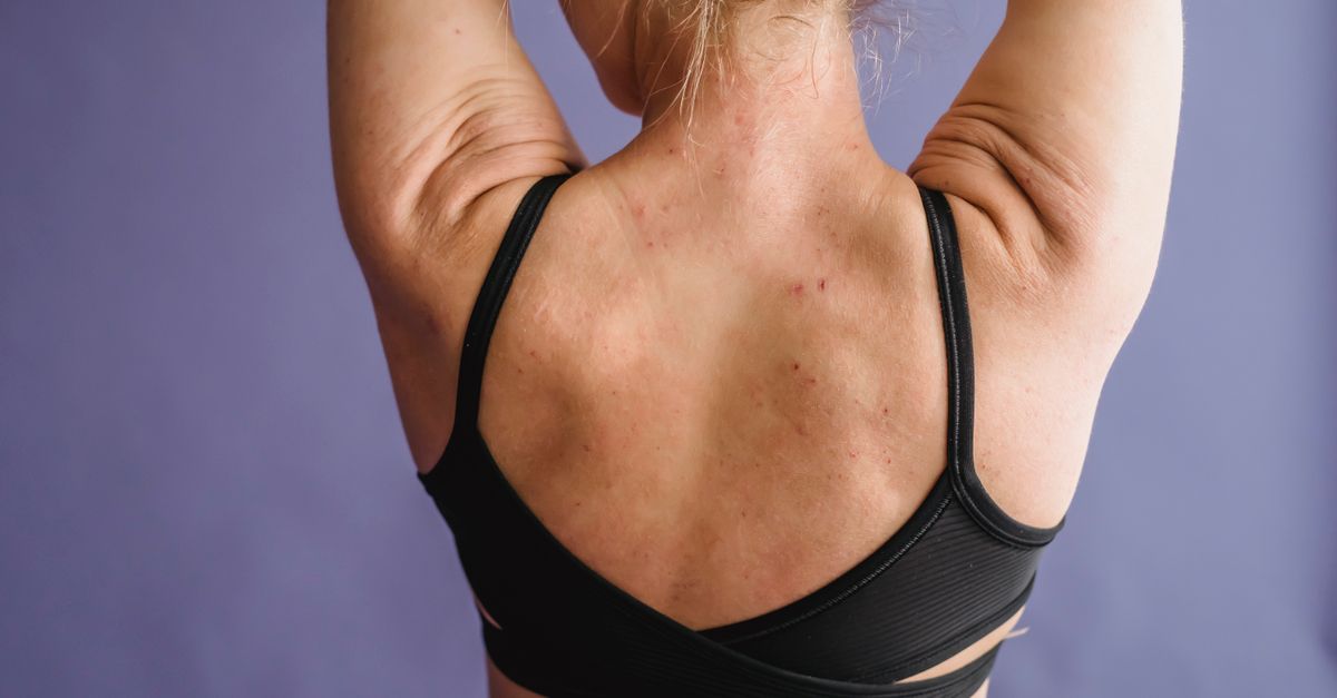 Why Do I Bruise More Easily Before My Period?
